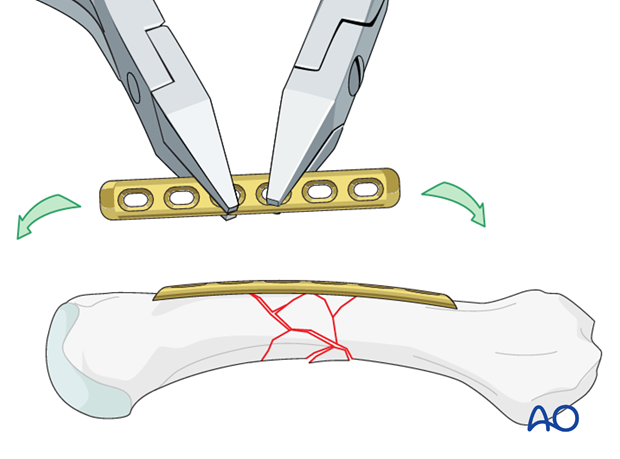 The plate is placed dorsally onto the metacarpal. The plate is contoured to conform with the normal shape of the metacarpal.