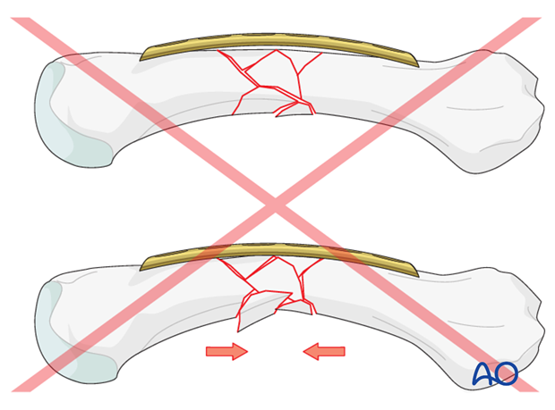 As there is to be no axial compression, overbending is not necessary and would result in a flexion deformity.