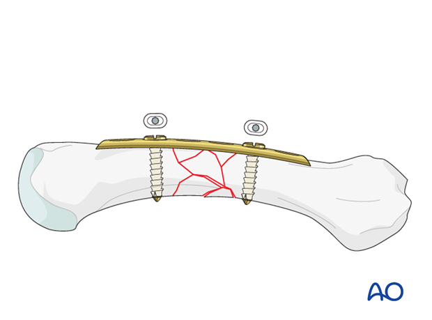 Make sure that the plate is correctly aligned in the longitudinal axis of the metacarpal. Insert a second neutral screw into ...
