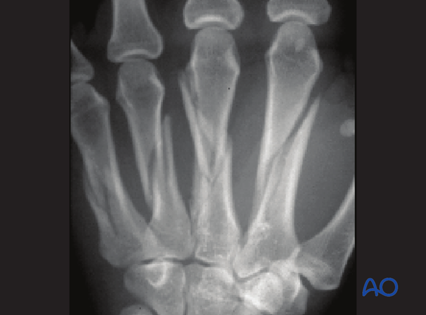 If all four metacarpals are fractured, fixation is started with the least comminuted, and then the adjacent metacarpals are ...
