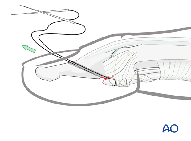 Now gently approximate the tendon to the fracture surface by pulling the sutures in a dorsal direction.