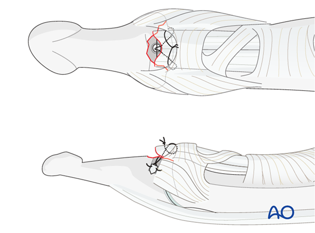 This option has the advantage of sparing the nail bed and nail from injury, and is a less time-consuming procedure.