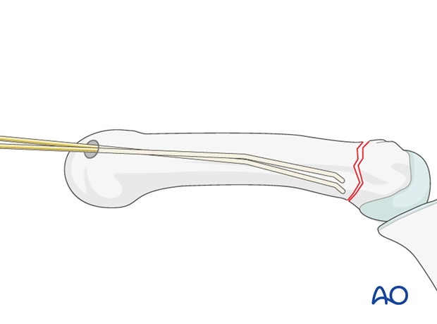 Two wires are inserted manually into the medullary canal and advanced into the diaphysis without reaching the fracture zone.