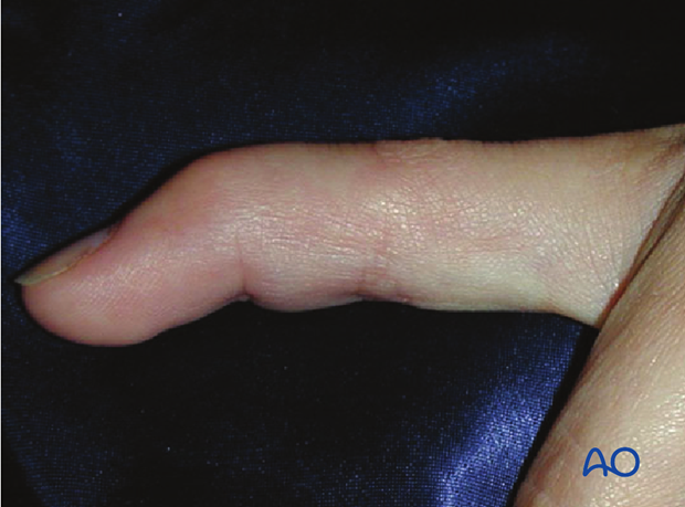 Discontinuities of the extensor insertion are often referred to as “mallet injury” or “baseball finger”.