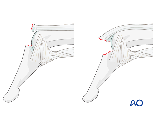 A similar clinical picture is presented by bony avulsion of the extensor mechanism at its insertion.