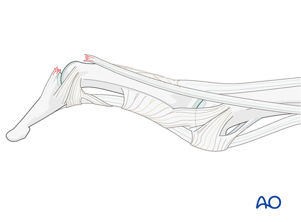 In some patients, elasticity of the ligaments and a lax PIP joint can result in swan-neck deformity, because after ...