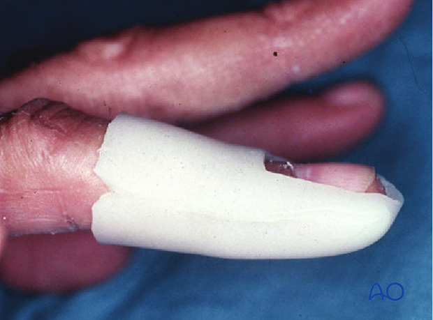 The hematoma can easily be released by puncturing the nail with a red-hot needle, or paperclip end.