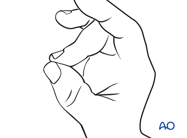 Instruct the patient to keep the finger in extension by pinching it with the thumb when the splint is taken off for ...