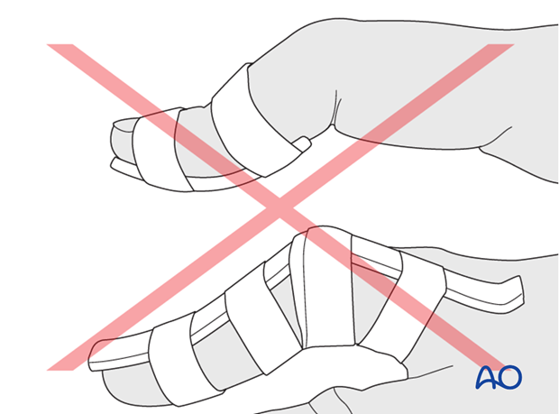 Do not attempt to immobilize the joint in hyperextension. This can compromise the precarious vascularization of the skin of ...