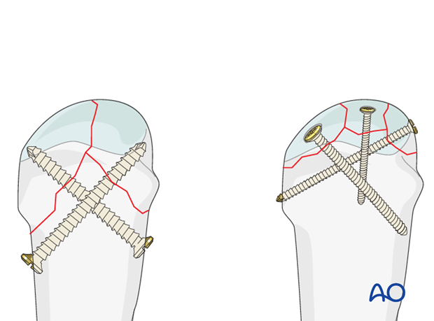 The fractures can usually be treated with screw fixation.