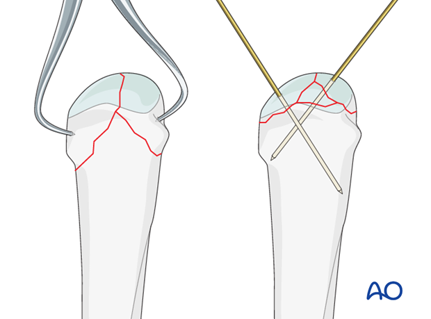 The articular fragments are manipulated using a dental pick, small K-wires, or a small periosteal ...