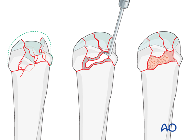 In impacted fractures, the articular surface is reduced, and the bony defect under the fragments is filled with bone graft ...