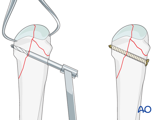 If the fragments extend to the metaphyseal region, bicortical lag screws can be used.