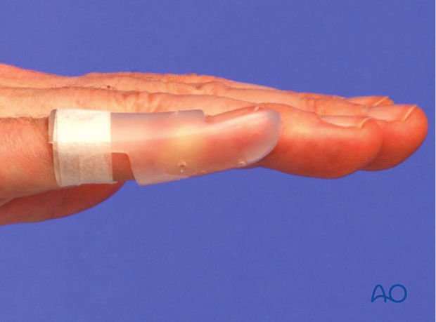 The advantage of a custom thermoplastic splint is that it is better adapted to the shape of the finger, and easier to change.
