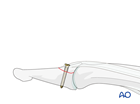 distal phalanx base dorsal avulsion