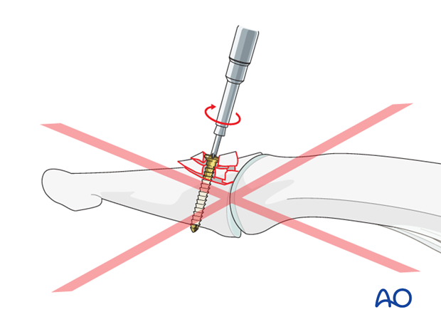 Be careful not to overtighten the screw as this may result in comminution of the fragment.