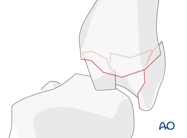 A typical site for metacarpal base fractures is the fifth metacarpal.