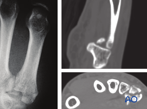 These fractures are usually fixed with plates, or K-wires in the case of small fragments, and may need bone grafting.