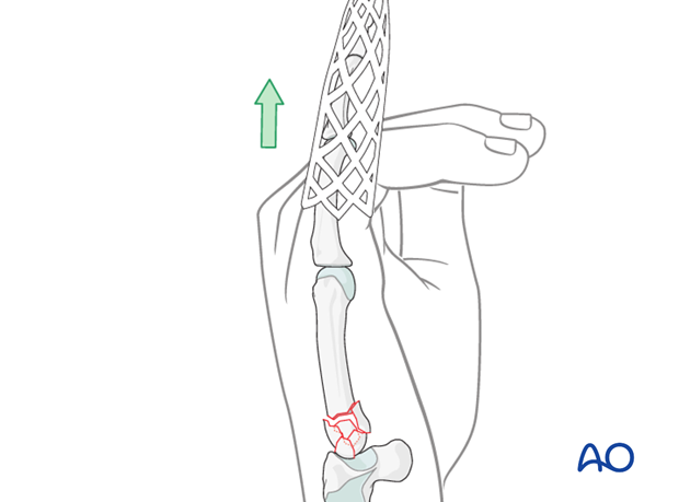 Apply axial traction on the finger, either manually or with a finger trap.