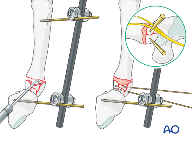 Use a dental, pick, a periosteal elevator, or small K-wires to reduce the fragments. Insert small K-wires for preliminary...