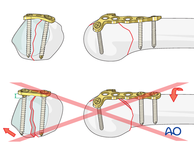 The plate must be contoured exactly to fit the surface of the metacarpal, including any necessary twisting.
