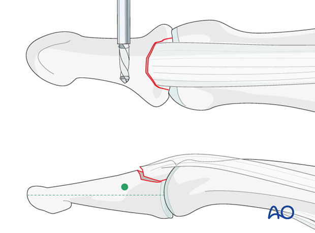 The drill hole must be located dorsal to the mid-axis of the distal phalanx.