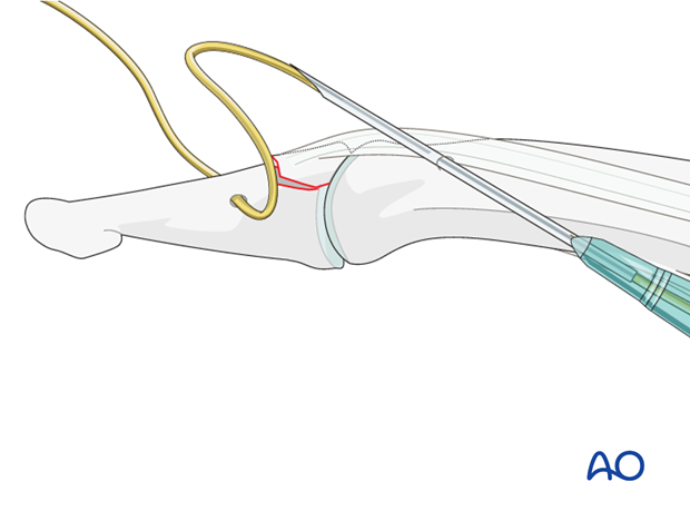 Do not place the wire on top of the terminal extensor tendon, as this may cause necrosis by pressure.