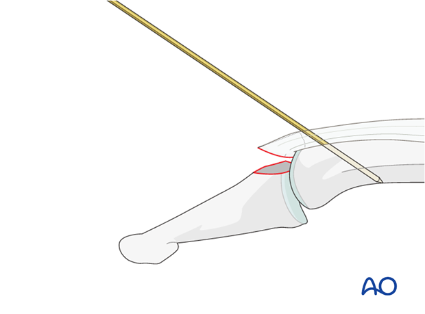 Use image intensification to determine the precise location of the DIP joint.