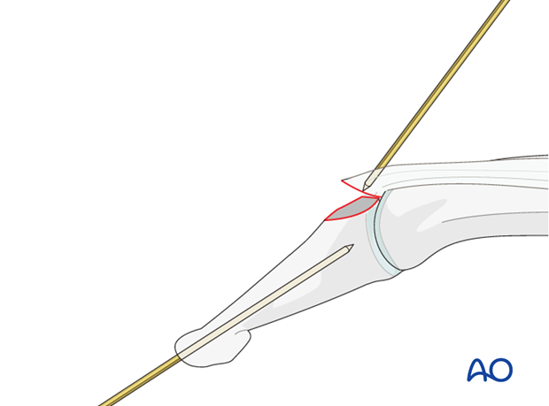 Advance the K-wire into the base of the distal phalanx.