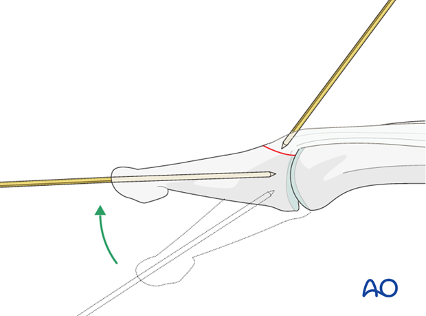 Use the axial K-wire as a joystick to extend the DIP joint and to reduce the fracture.
