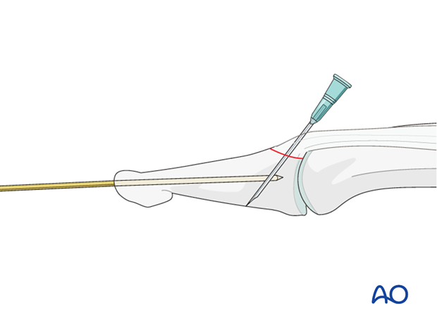 Instead of a K-wire, a 26 insulin needle can be used for fixing the fracture.