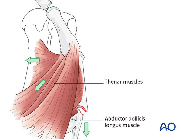 The pull of the thenar muscles results in palmar flexion of the distal fragment.