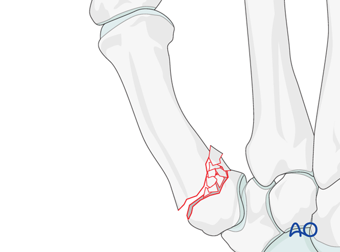 Locking compression plate (LCP) fixation for Metacarpal, base
