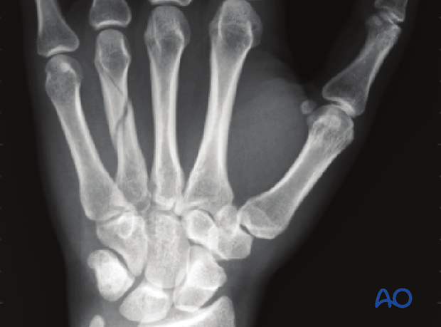 Undisplaced or minimally displaced fractures of the metacarpal shaft can be treated nonoperatively. Most of these fractures ...