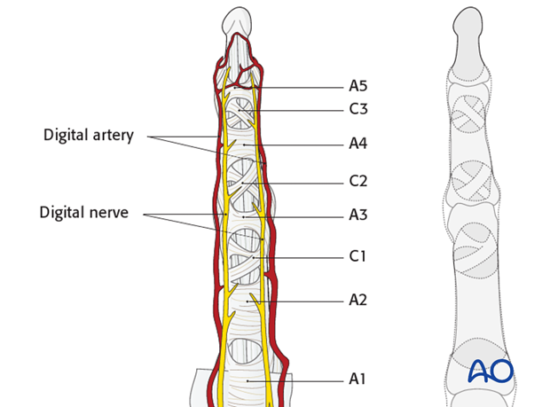 When approaching the PIP joint, take care to preserve the digital arteries and nerve.