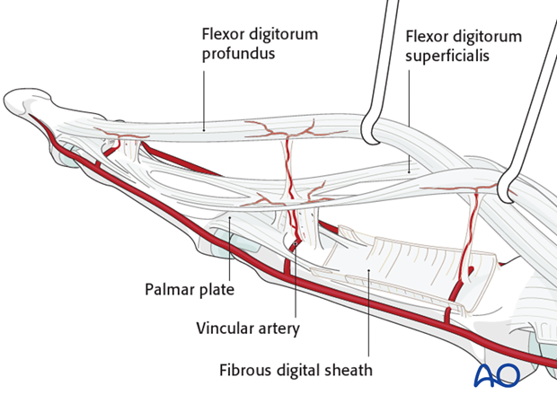 The vincular arteries are delicate, but essential to the vascularity of the flexor tendons. They must be preserved whenever ...