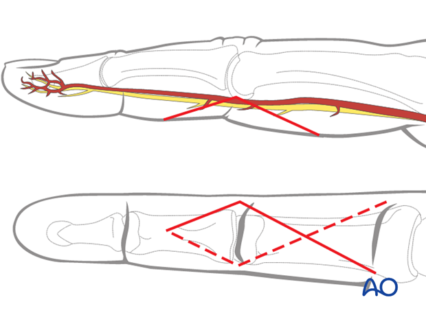 The apex of the angle should be at the end of the intermediate flexor crease, level with the PIP joint.