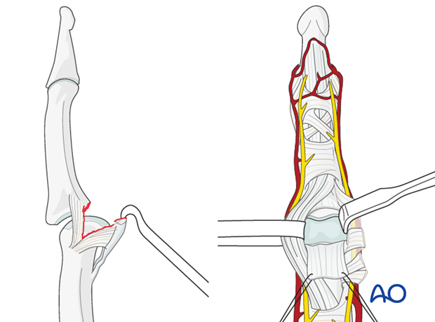 Extension of the PIP joint now exposes the distal edge of the volar plate, which often bears a fracture fragment ...