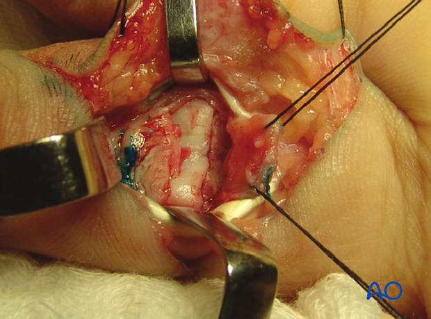 In the event that the volar plate is attached to small palmar fragments not suitable for fixation, and a volar plate ...