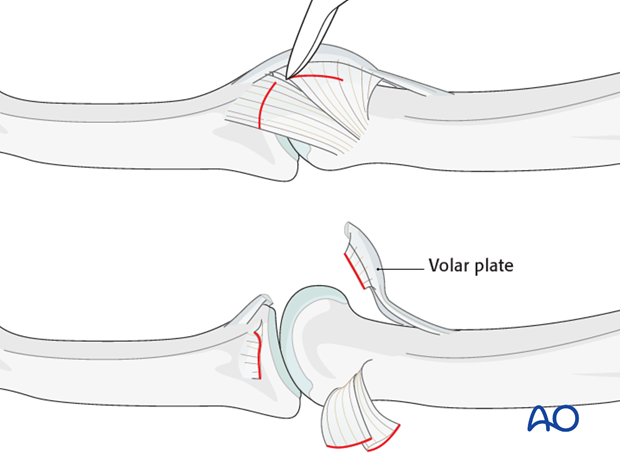 The distal and palmar attachments of the collateral ligaments should be detached bilaterally, and retracted dorsally.