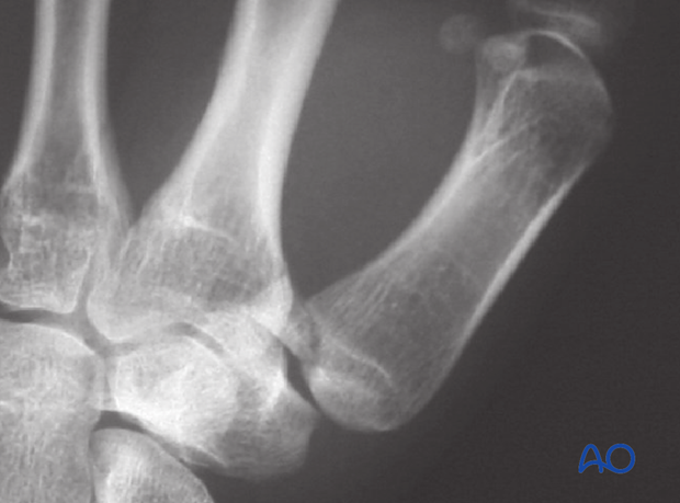 The treatment goals are to reposition the first metacarpal in the carpo-metacarpal joint, and to restore the articular surface.