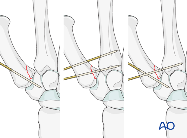 Closed reduction and internal fixation comprise the treatment of choice for most of Bennett’s fractures.
