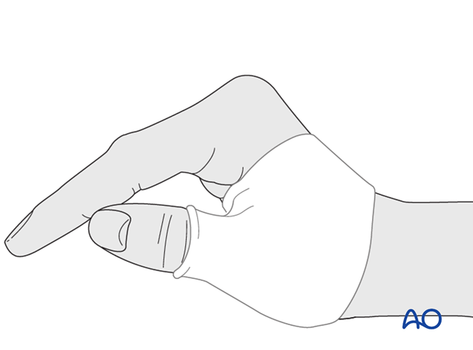 Ligament reattachment with suture anchors for Proximal phalanx, base ...