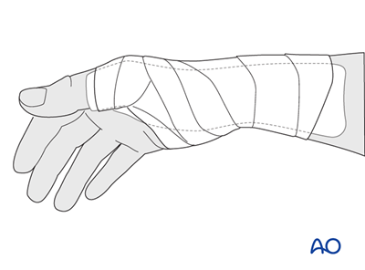 Ligament reattachment with suture anchors for Proximal phalanx, base ...