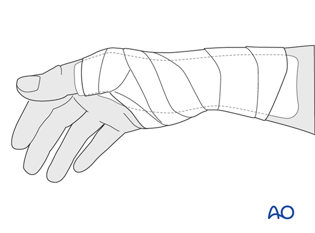 Immediately postoperatively, a temporary plaster splint is applied which immobilizes the first MCP joint as well as the wrist. When the pain and swelling have reduced, a custom thermoplastic splint is applied for a period of time depending on ...