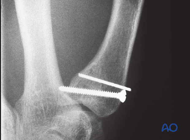 If the palmar marginal fragment comprises less than one third of the articular surface, one screw and a K-wire are used.