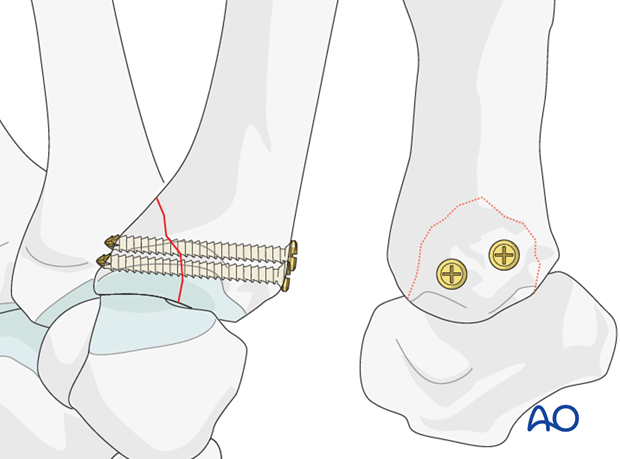 If the fragment comprises more than one third of the articular surface, two screws are used.