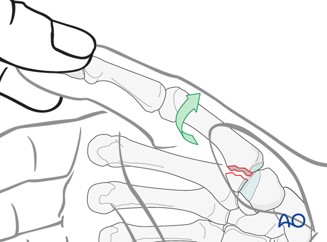 Lag Screw Fixation For Metacarpal Bennett Fracture 7669