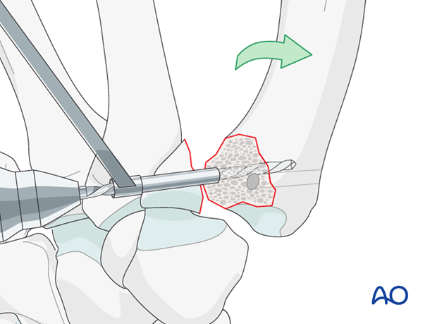 In case of a large palmar marginal fragment, two screws are used.