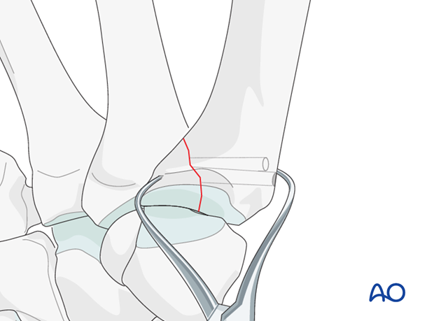 After drilling the glide holes, reduce the fracture by pronation of the metacarpal, and secure with pointed reduction forceps.